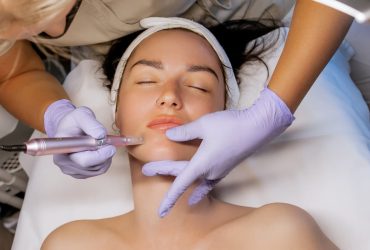 Microneedling