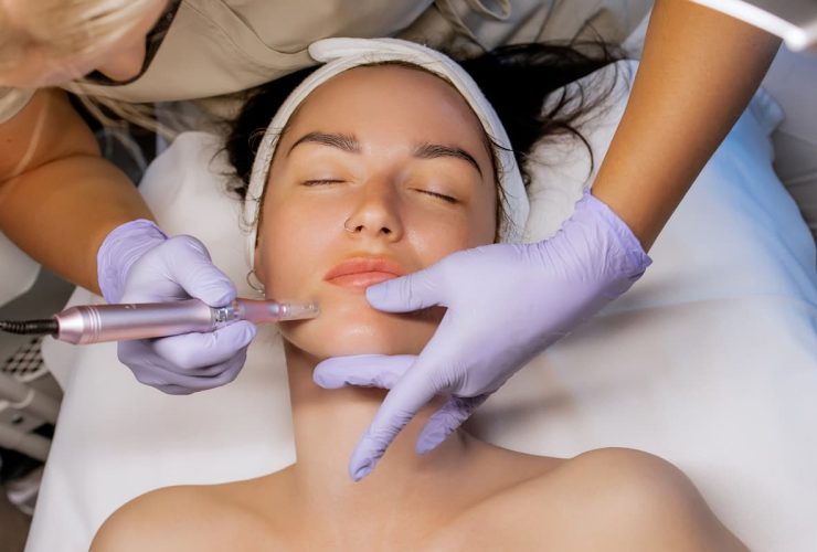 Microneedling